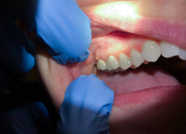 Best Emergency Denture Repair in Shingletown, CA