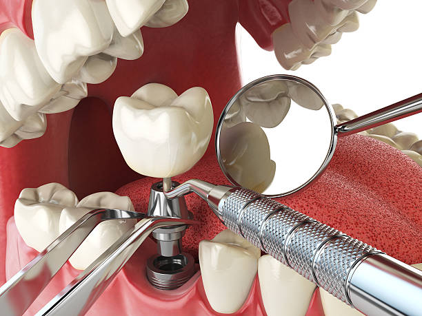 Best Emergency Treatment for Dental Infections or Abscesses in Shingletown, CA